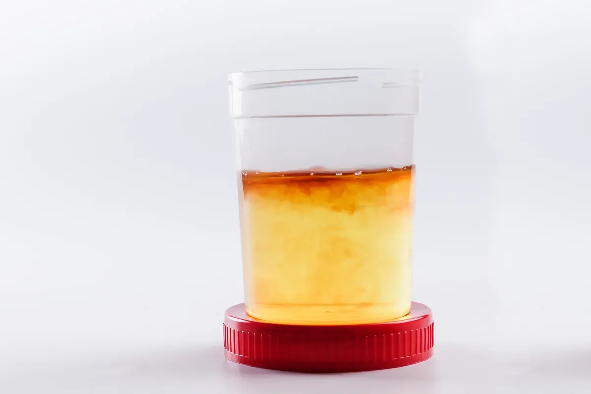 Blood in Urine After Exercise: What Men Need to Know