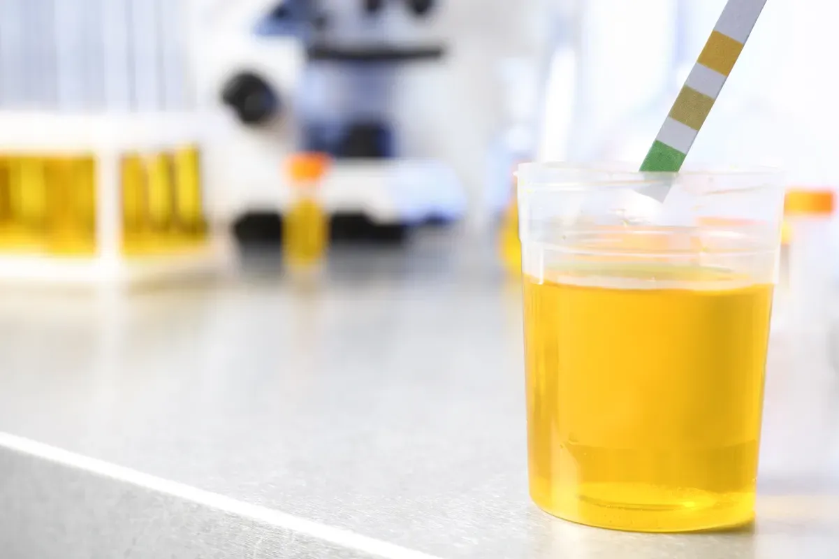 Is Bubbly or Foamy Urine Caused by Kidney Disease?
