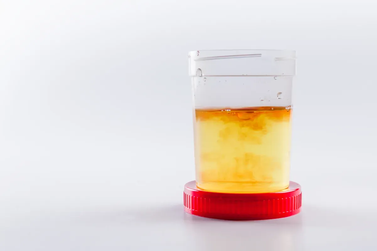 Causes of Blood in Urine (Haematuria)