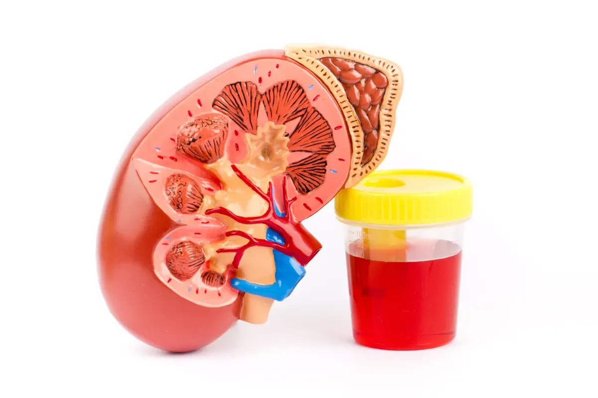 Haematuria: Diagnostic Tests for Blood in Urine