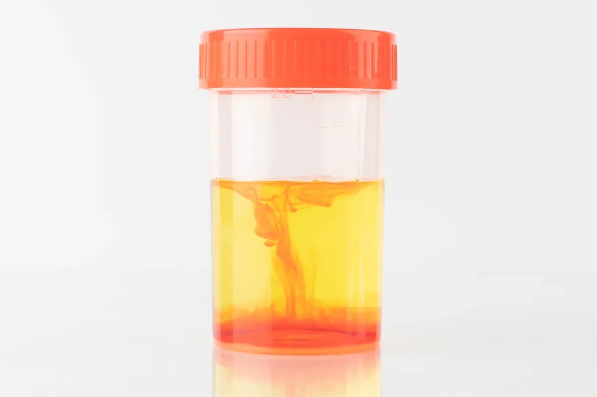 Exploring the Genetic Factors of Haematuria (Blood in Urine)