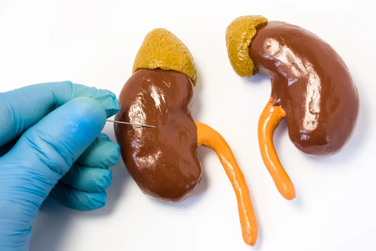 Understanding Glomerulonephritis: Types, Symptoms, and Diagnosis