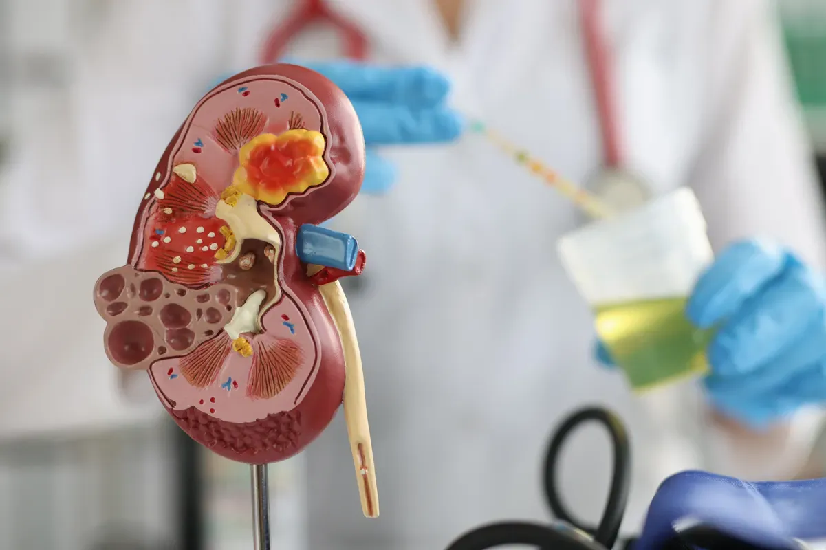 Haematuria in Kidney Disease: What You Need to Know