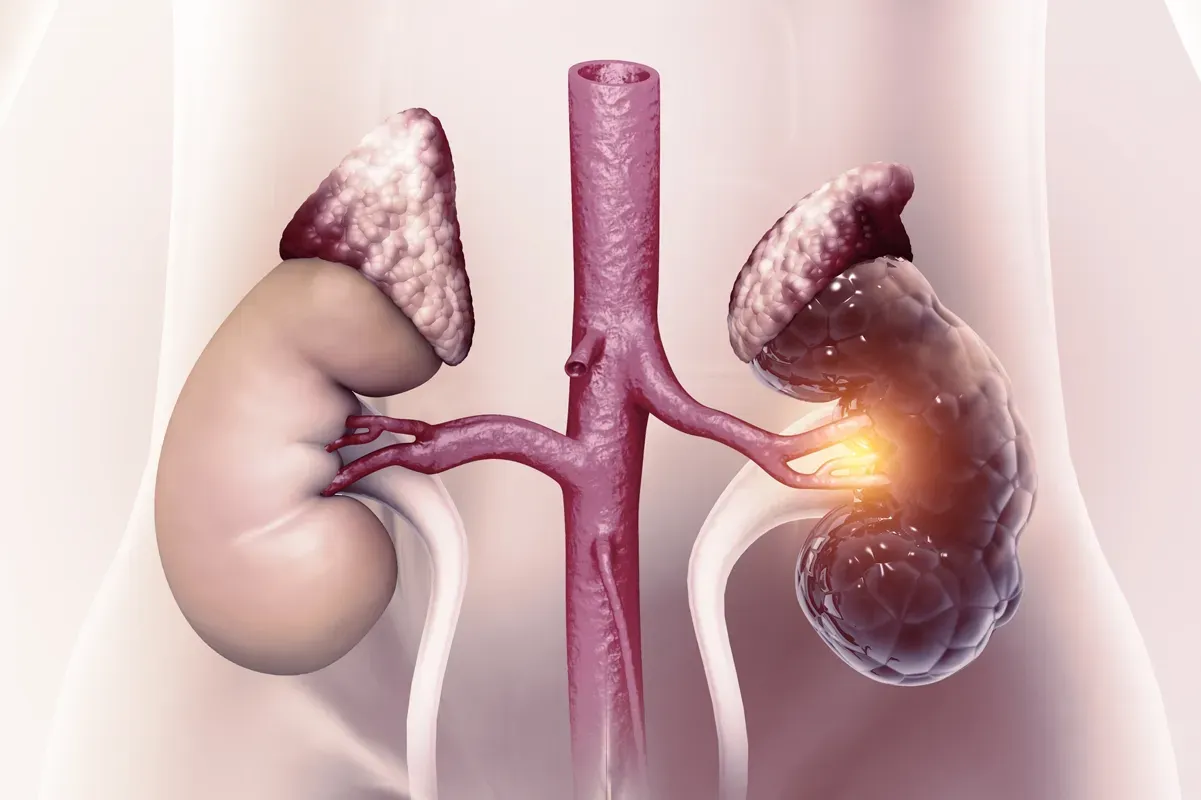 Kidney Failure: Causes, Symptoms, and Treatment