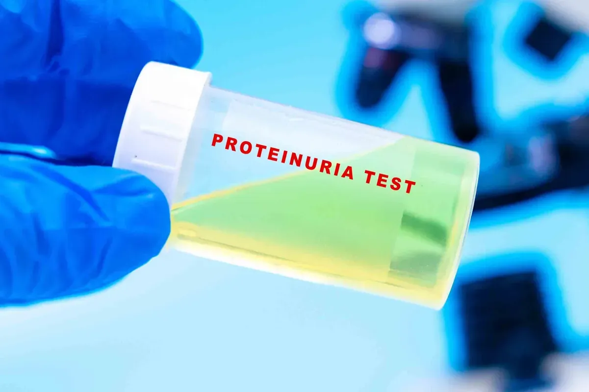 How to Manage Protein in Urine (Proteinuria)