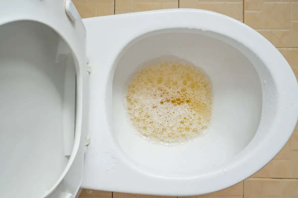 How Bubbly or Foamy Urine (Proteinuria) Can Indicate Kidney Disease